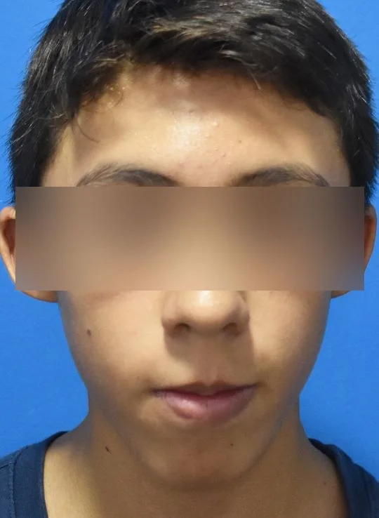 Antes, Vista frontal, reposo · Paciente I (con consentimiento; identidad anonimizada)