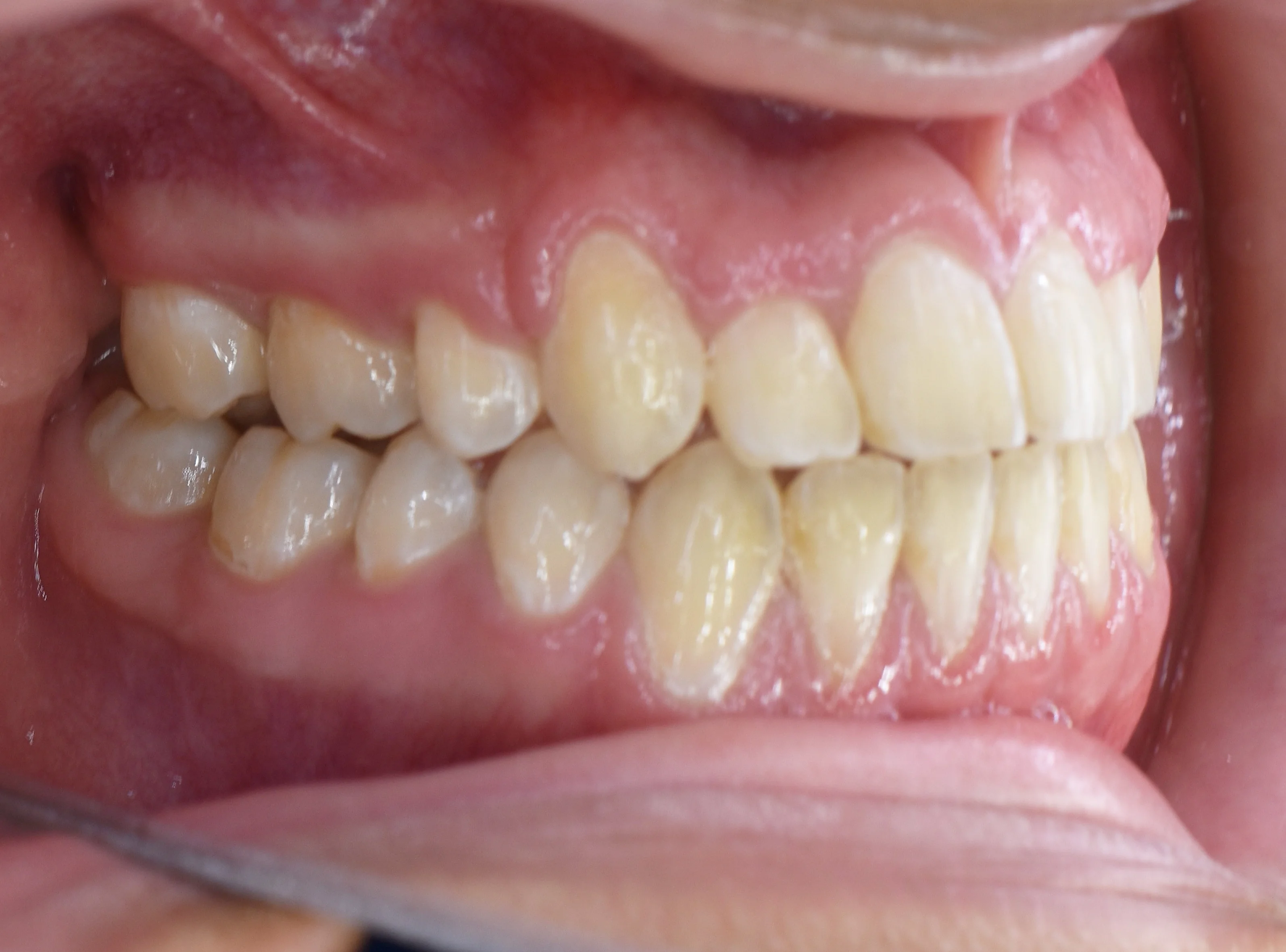 Después, Vista intraoral lateral derecha · Paciente I (con consentimiento; identidad anonimizada)