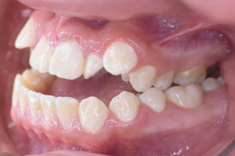 Antes, Vista intraoral lateral derecha · Paciente I (con consentimiento; identidad anonimizada)