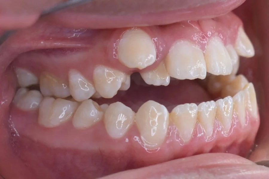 Antes, Vista intraoral lateral izquierda · Paciente I (con consentimiento; identidad anonimizada)