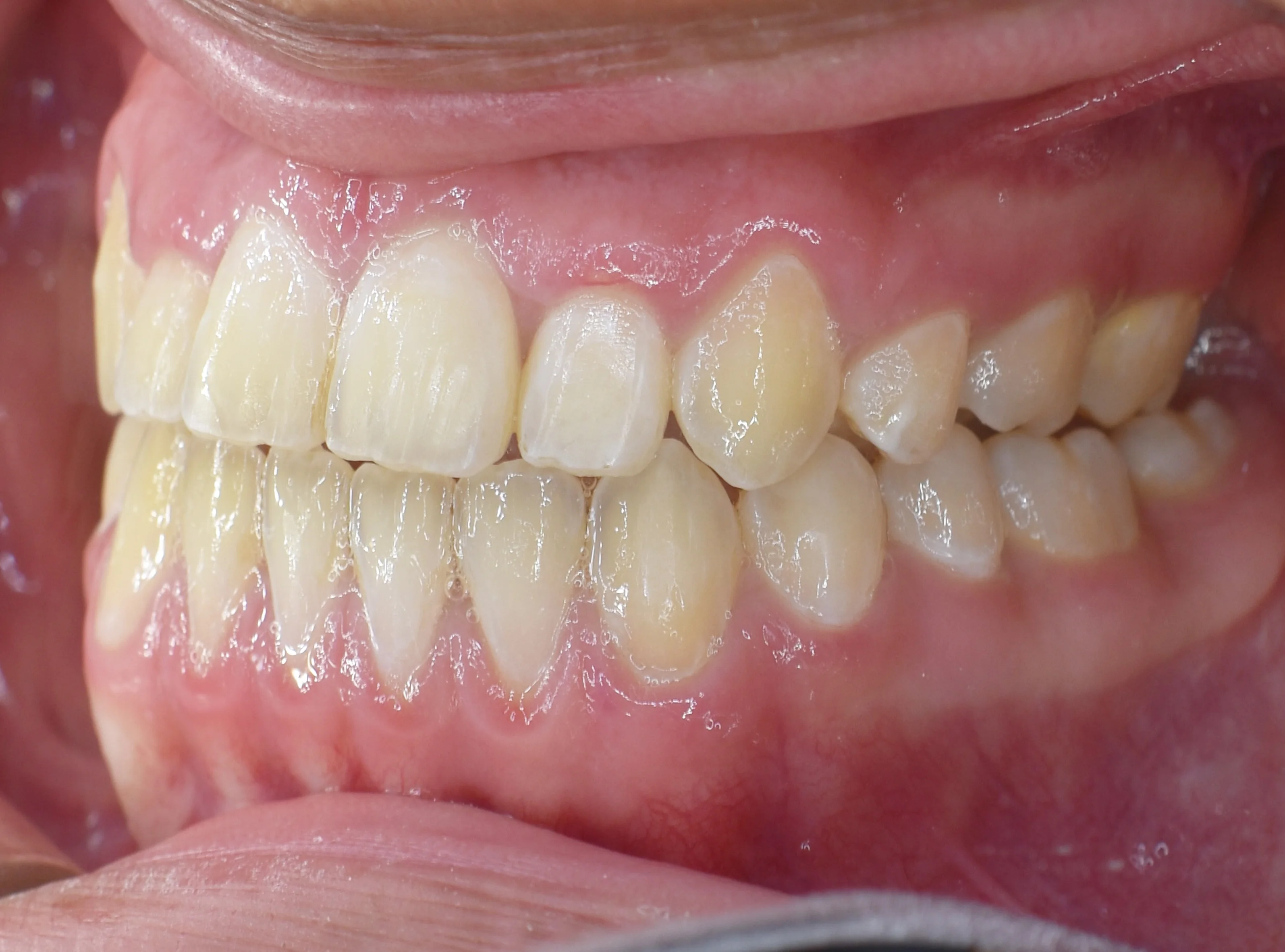 Después, Vista intraoral lateral izquierda · Paciente I (con consentimiento; identidad anonimizada)