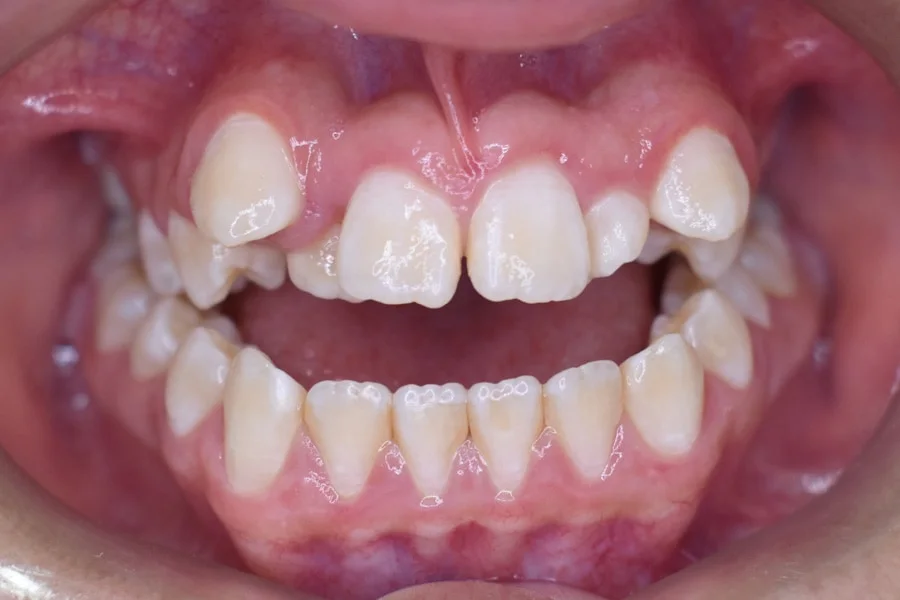 Antes, Mordida, vista intraoral frontal · Paciente I (con consentimiento; identidad anonimizada)