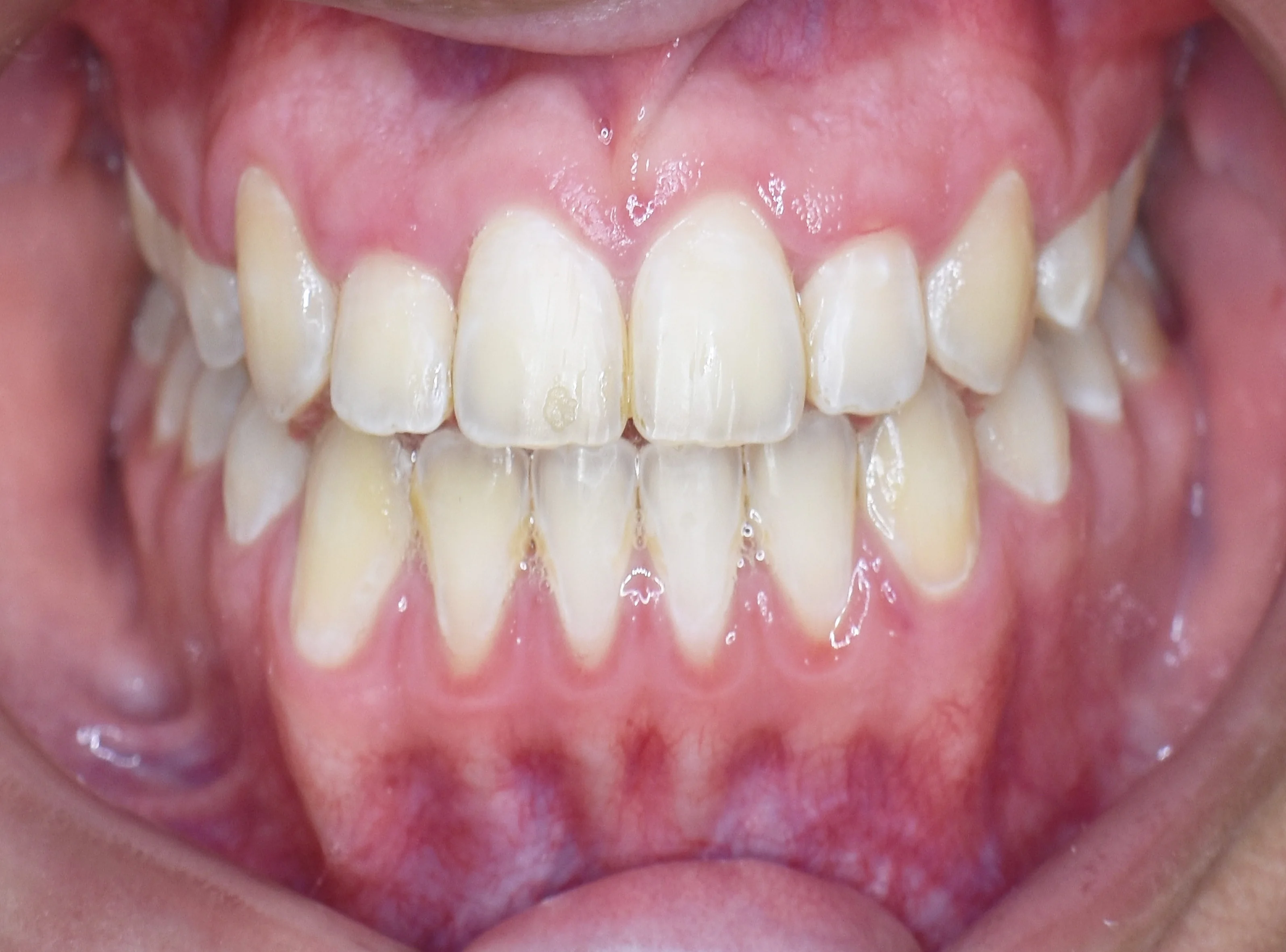 Después, Mordida, vista intraoral frontal · Paciente I (con consentimiento; identidad anonimizada)