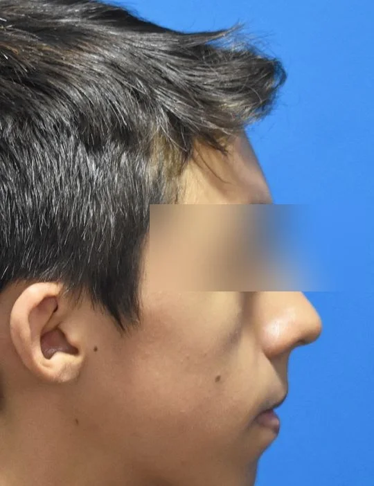 Antes, Perfil · Paciente I (con consentimiento; identidad anonimizada)